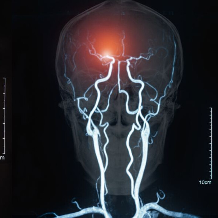 Prostatită după un accident vascular cerebral în 70 de ani