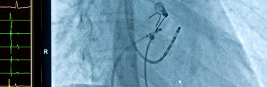 Ablatie cardiaca | Tratamentul eficient al aritmiilor