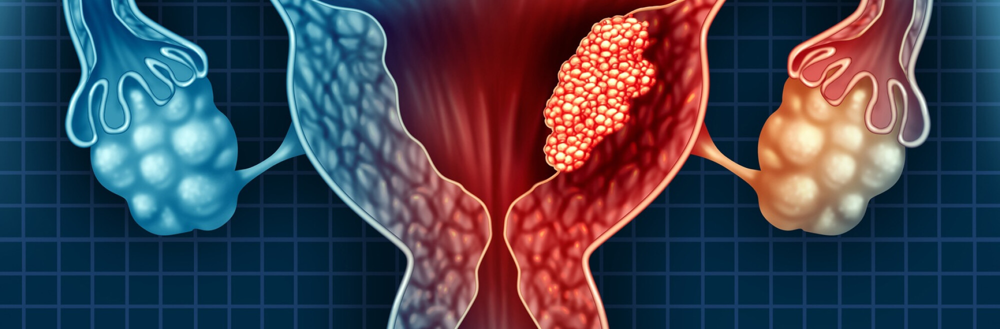 Cancerul De Endometru Chirurgie Cancer