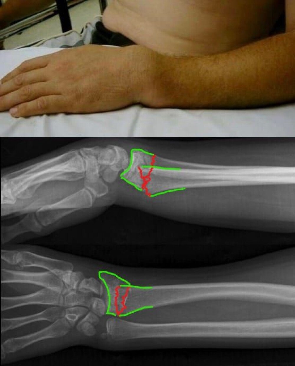 Tratamentul fracturilor la încheietura mâinii